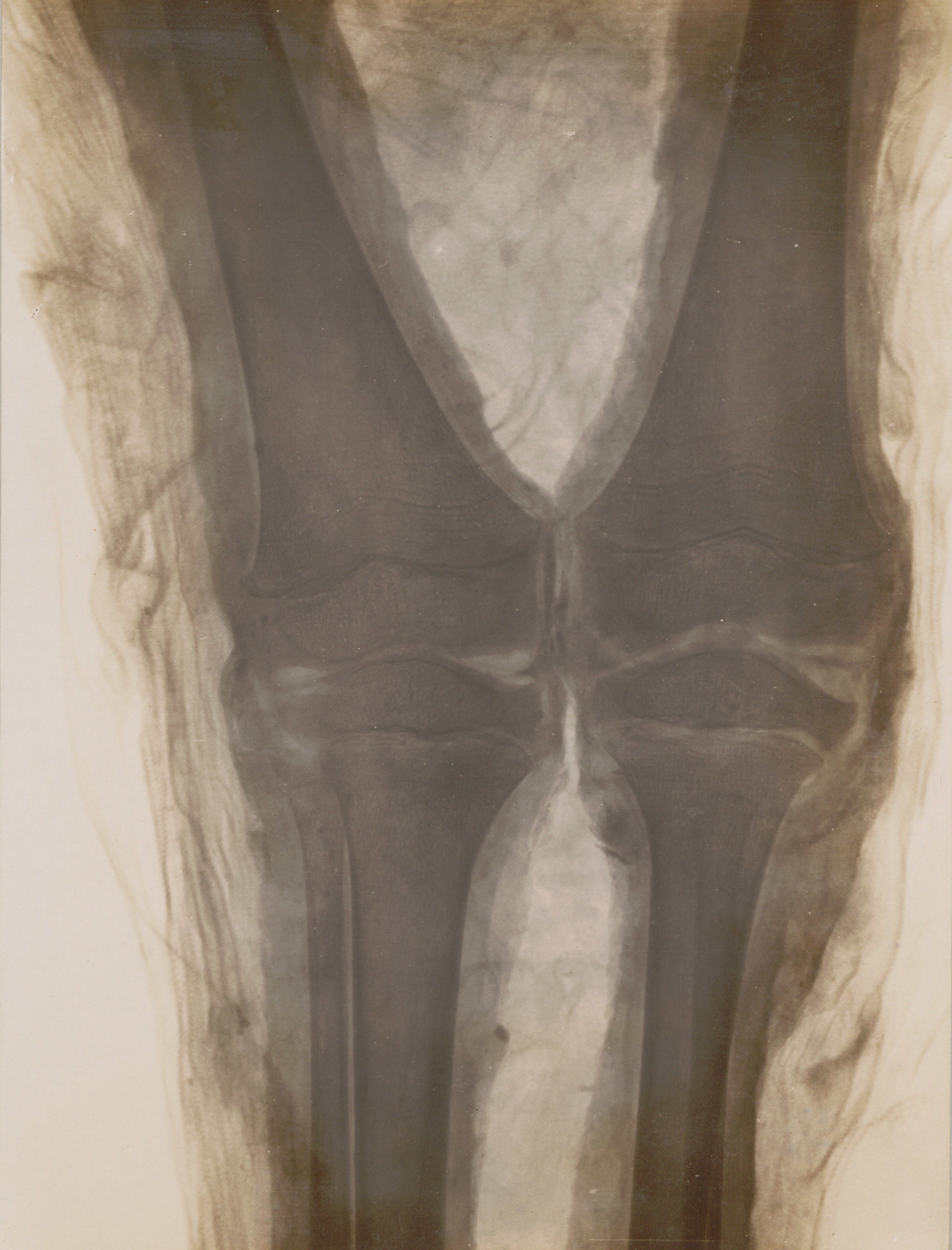 1896 x-rays of Physikalischer Verein, mummy